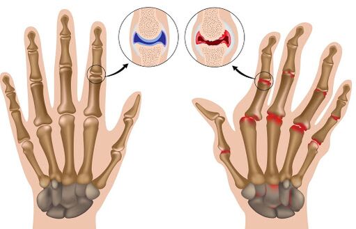 Arthritis disease and its manifestation