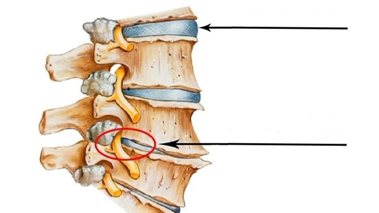 spinal cord injury in cervical osteochondrosis