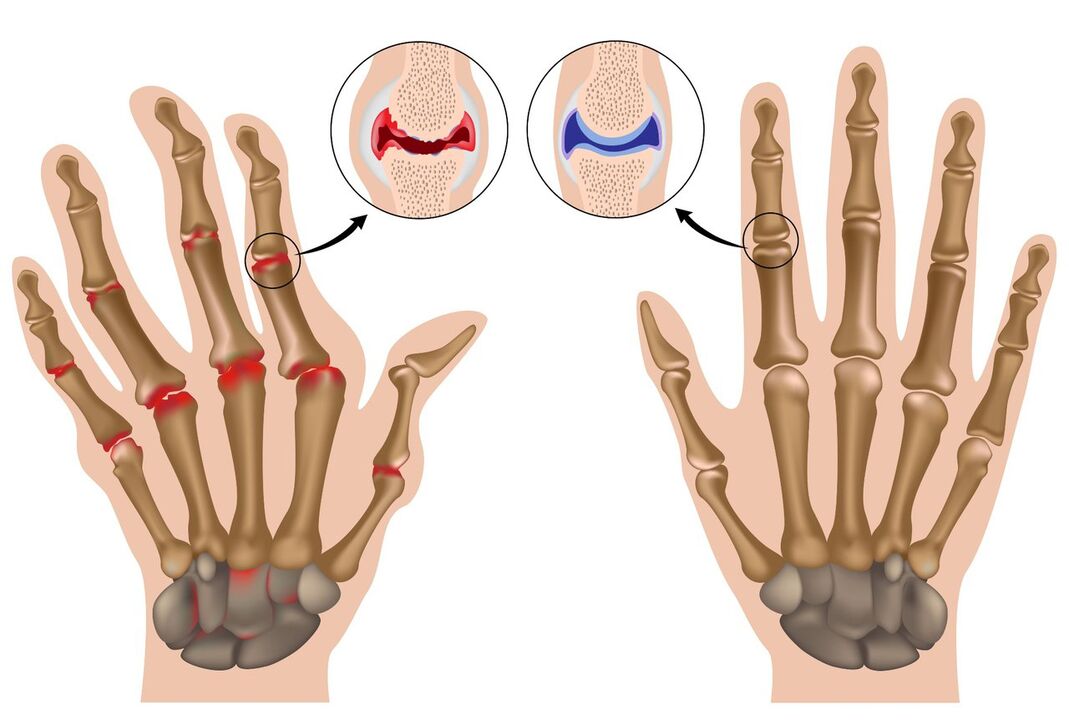 Healthy and polyarthritis affected hand joints