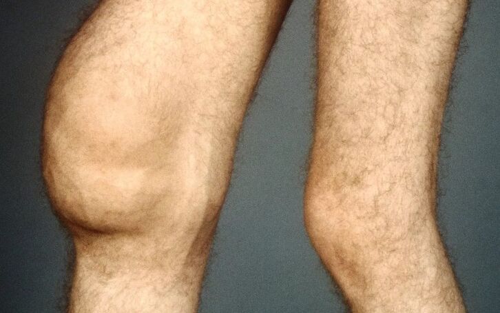 Post -traumatic knee arthrosis joint