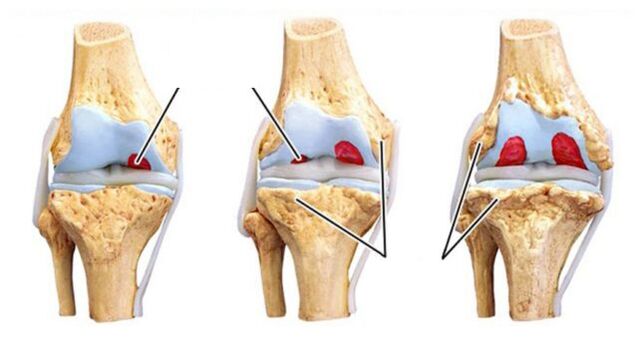 Complications of arthrosis of the joints