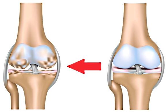 Healthy joint and arthrosis