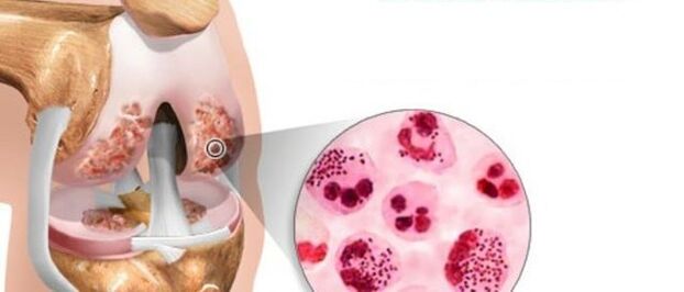 which leads to the development of arthrosis
