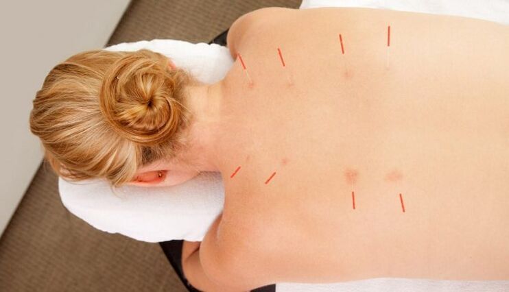 Acupuncture for thoracic osteochondrosis, which has many advantages